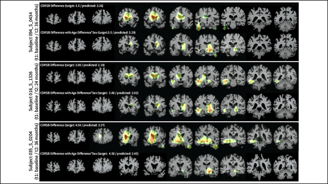 Heejong Kim/Provided Heatmaps highlight the areas LILAC focuses on when making predictions. The top section illustrates LILAC’s prediction of changes in the Clinical Dementia Rating Scale Sum of Boxes, while the bottom section accounts for age and sex as additional factors.